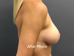 Breast augmentation after photo showcasing natural results at Lentz Plastic Surgery.