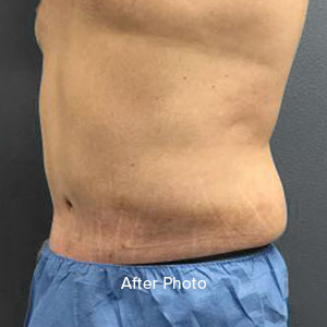 Male abdomen after plastic surgery, showcasing improved contour and skin texture.