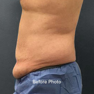 Male patient before abdominal contouring procedure at Lentz Plastic Surgery.