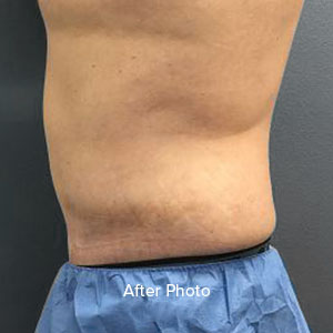 Post-surgery side view of abdomen, showcasing results from Lentz Plastic Surgery.