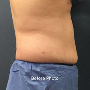 Male torso before body contouring procedure at Lentz Plastic Surgery.