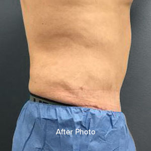 Post-surgery torso showcasing improved contour and skin texture.