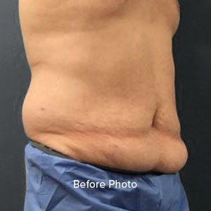 Male patient’s side profile before body contouring procedure at Lentz Plastic Surgery.