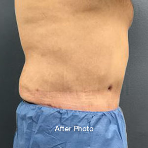 Post-surgery torso showing improved contour and skin texture. Lentz Plastic Surgery.