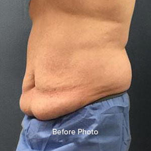 Before photo of male abdomen, highlighting excess skin and fat for surgery consultation.