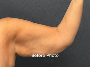 Before photo of toned arm showcasing Lentz Plastic Surgery results.
