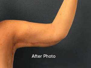 After photo of arm post-surgery, showcasing improved contour and skin tone.