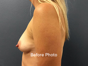 Before photo showcasing breast enhancement consultation at Lentz Plastic Surgery.