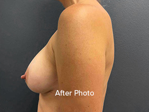 Breast augmentation after photo showcasing natural results and professional care.
