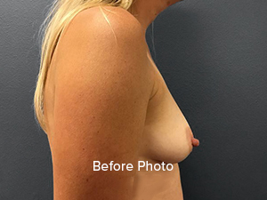 Before photo of breast augmentation patient, highlighting natural contours.