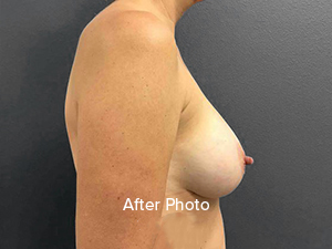 Post-surgery profile view showcasing enhanced breast aesthetics.