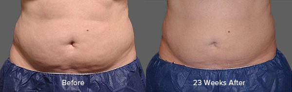 CoolSculpting Result