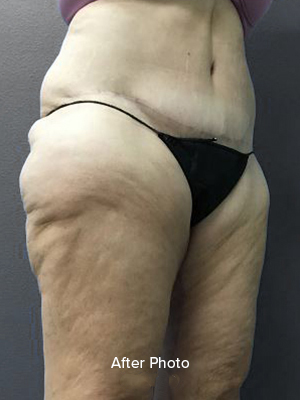 Post-surgery body contouring results showcasing improved skin smoothness.