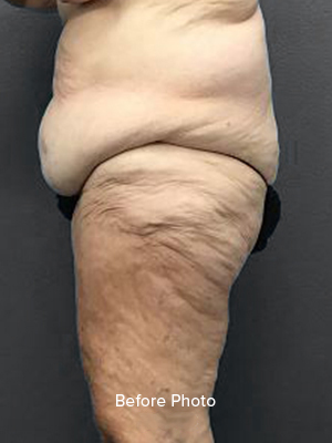 Before photo showcasing skin texture and contour issues for Lentz Plastic Surgery.