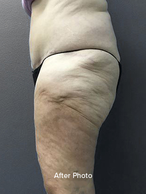 Post-surgery thigh transformation showcasing improved skin texture and contour.