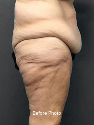 Before photo showcasing thigh area with skin laxity, relevant for Lentz Plastic Surgery.