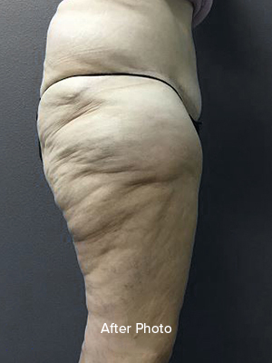 Post-surgery thigh with visible skin texture improvement at Lentz Plastic Surgery.
