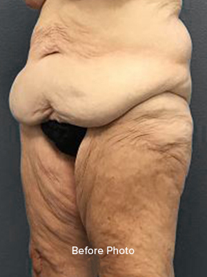 Before photo showcasing skin laxity and contour issues for Lentz Plastic Surgery.