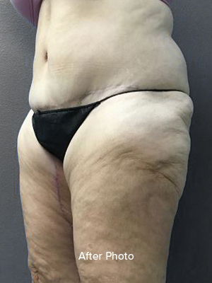 Post-surgery body contouring results highlighting smoother skin texture.