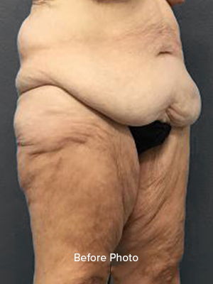 Before photo highlighting body contouring results at Lentz Plastic Surgery.