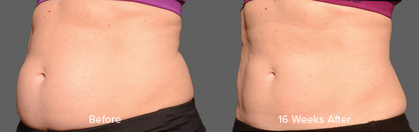 CoolSculpting Result