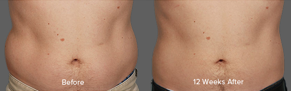 CoolSculpting Result
