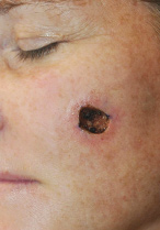 Basal Cell Carcinoma