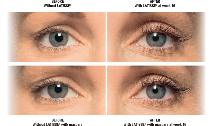 Eyelashes Growth, Latisse