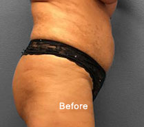 Before image showcasing body contouring results at Lentz Plastic Surgery.