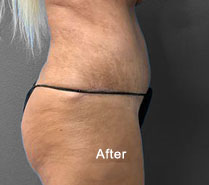 Post-surgery side view showcasing improved skin texture and contour.