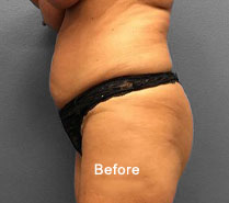 Before image showcasing body contouring results at Lentz Plastic Surgery.