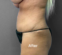 Post-surgery side view showcasing improved body contour and skin texture.