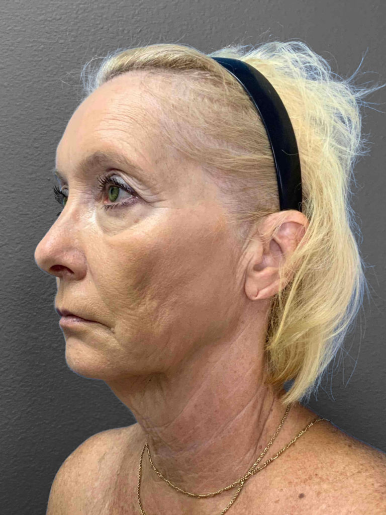 Profile view of a woman showcasing natural skin texture and subtle aging signs.