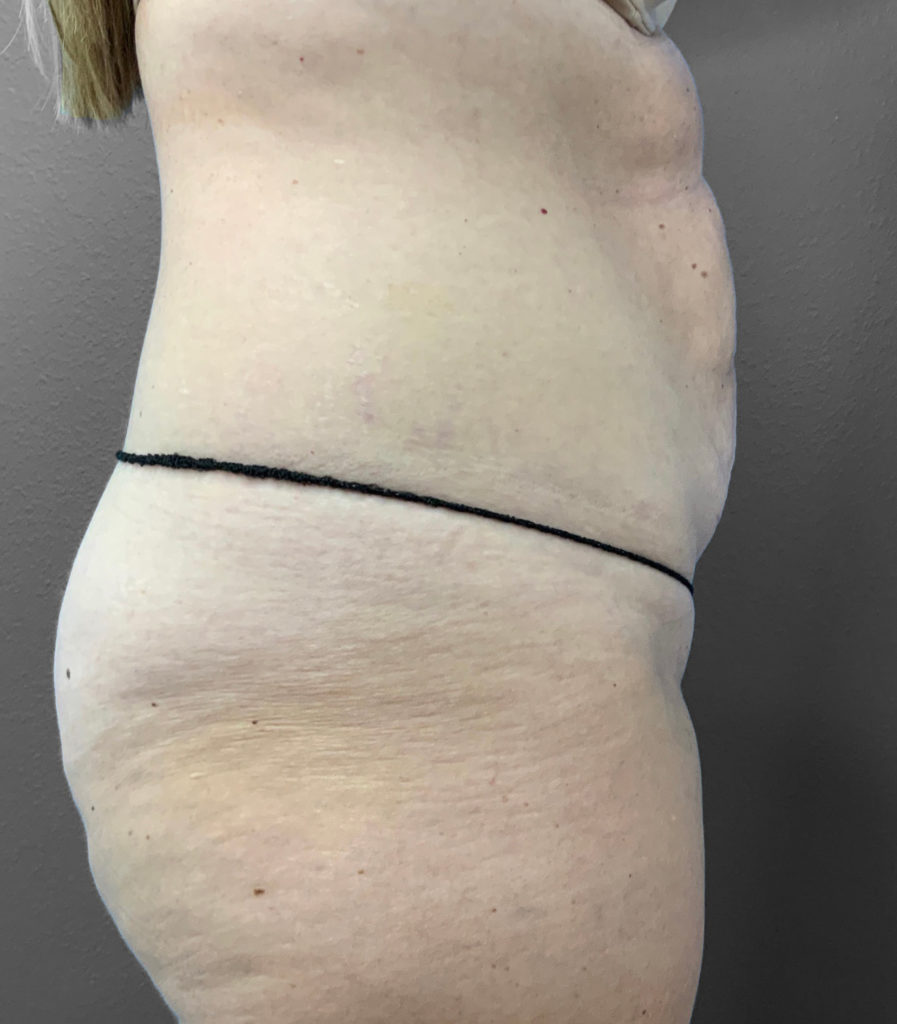 Side view of abdomen highlighting skin texture and contour for plastic surgery consultation.