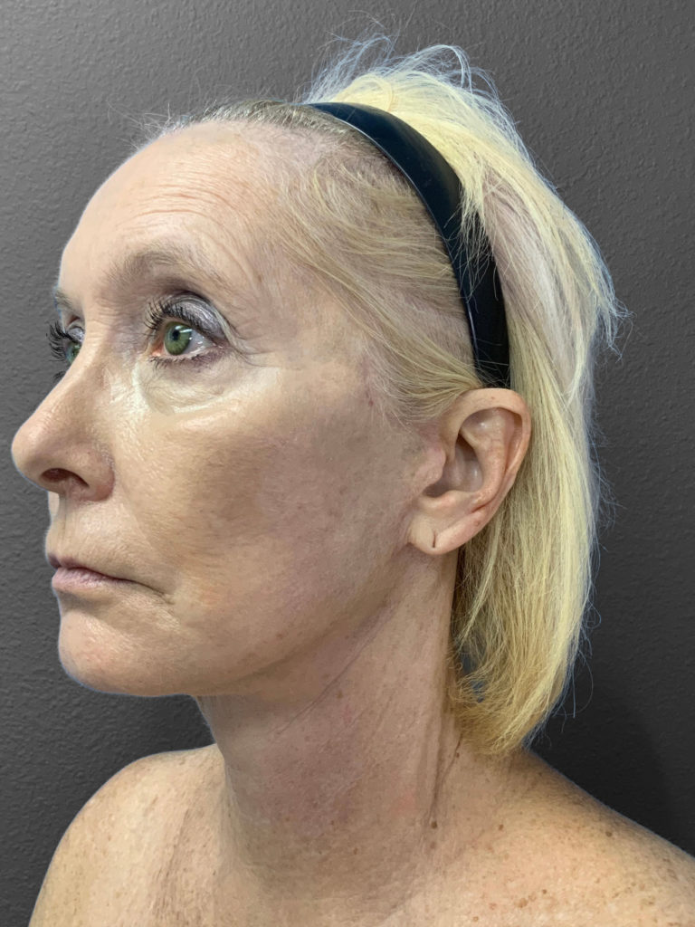 Profile view of a woman with natural skin texture, highlighting aesthetic results.