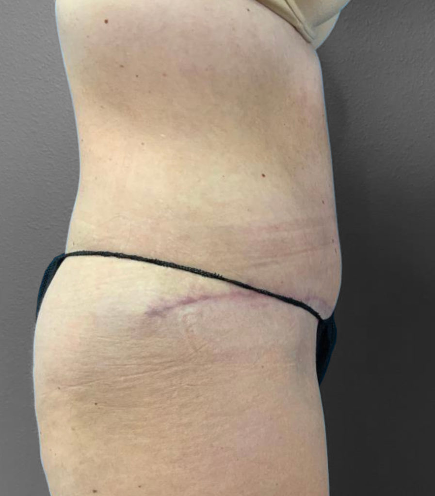 Post-operative side view showcasing surgical results at Lentz Plastic Surgery.