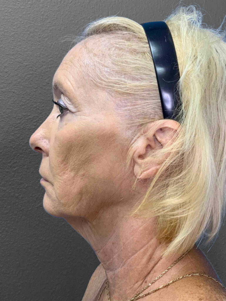 Profile view of mature woman highlighting facial contours post-surgery.
