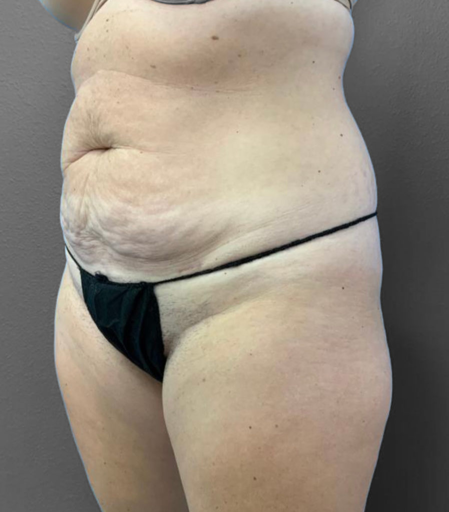 Before and after body contouring results at Lentz Plastic Surgery.