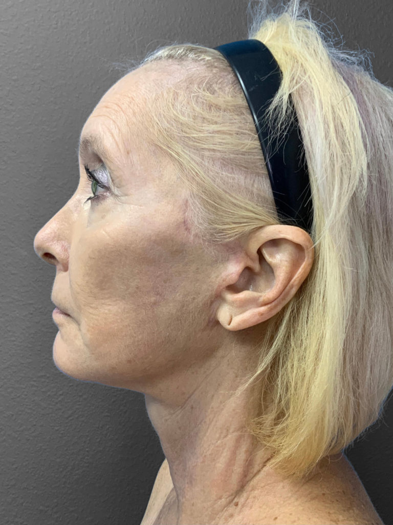 Profile view of a woman post-surgery, highlighting natural results and professional care.