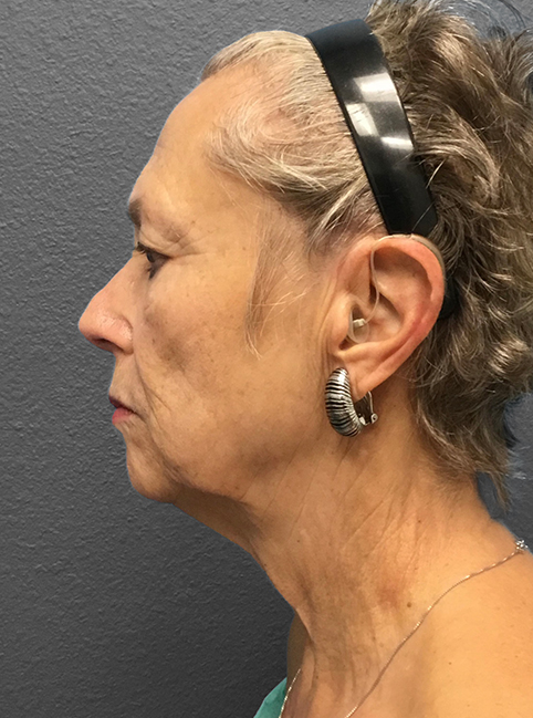 Profile view of mature woman highlighting facial contours and earlobe aesthetics.