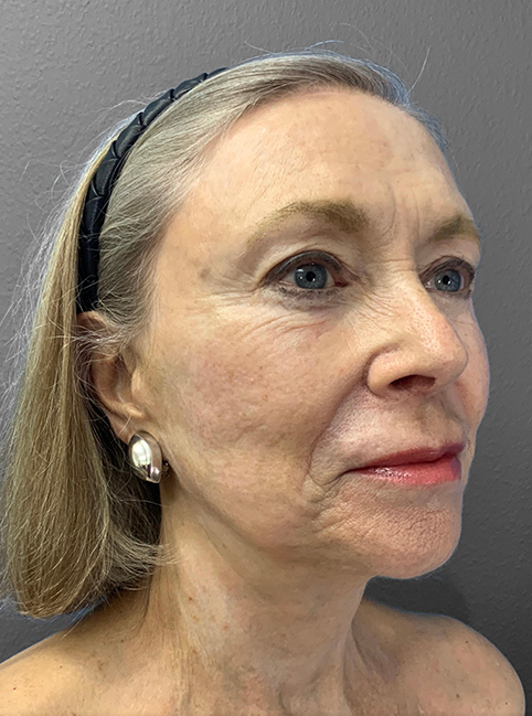 Patient consultation highlighting natural beauty and professional care at Lentz Plastic Surgery.