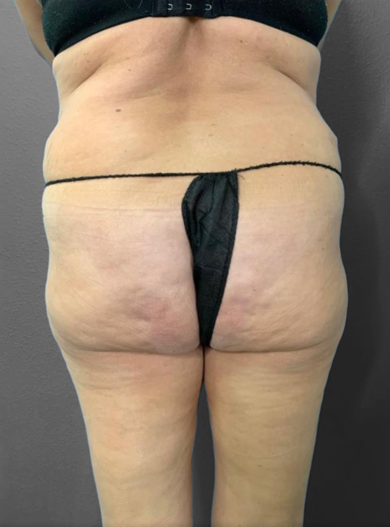 Before and after body contouring results, showcasing improved skin texture.