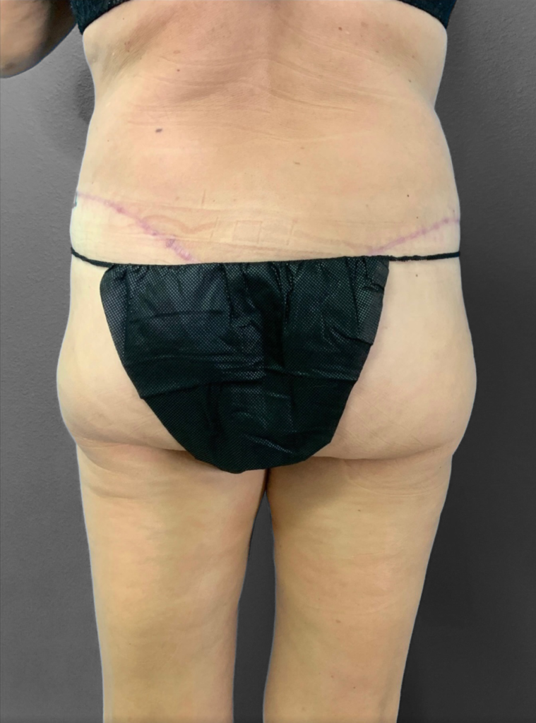 Post-surgery back view highlighting Lentz Plastic Surgery's expertise in body contouring.