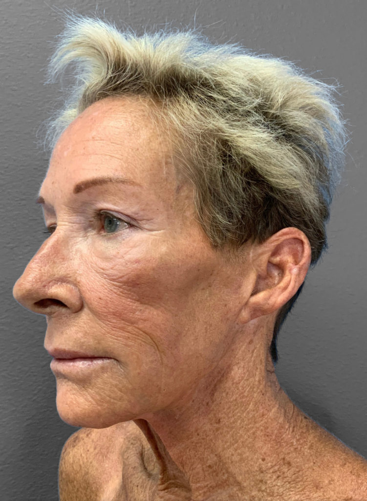 Profile view of a mature woman showcasing natural skin texture post-treatment.
