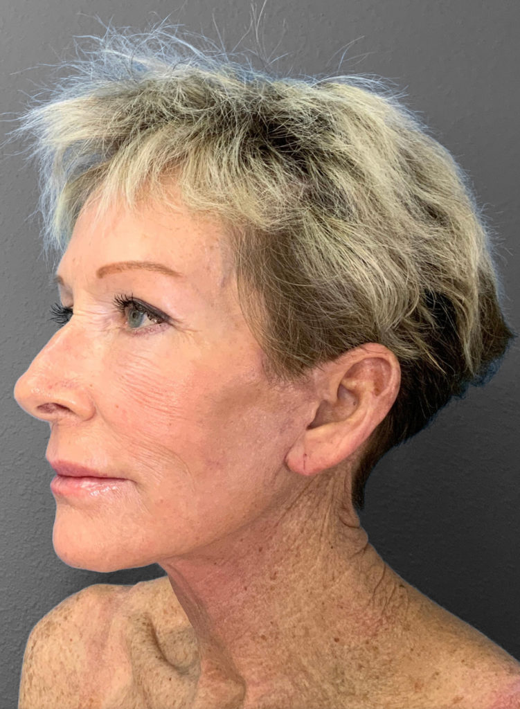 Profile view of a mature woman showcasing natural facial rejuvenation results.