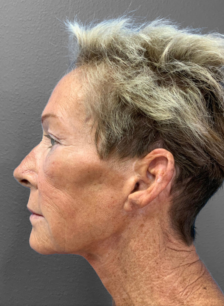Profile view of a mature woman highlighting facial rejuvenation results.