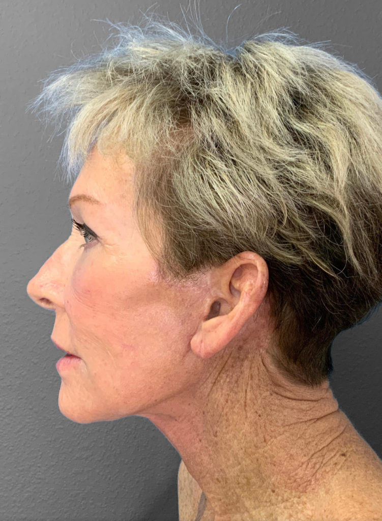 Profile view of a woman showcasing rejuvenated skin after Lentz Plastic Surgery.