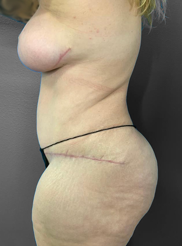 Post-surgery profile view highlighting body contouring results.