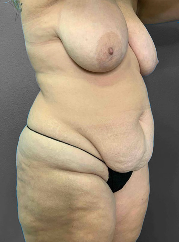 Before and after body contouring results showcasing enhanced silhouette.