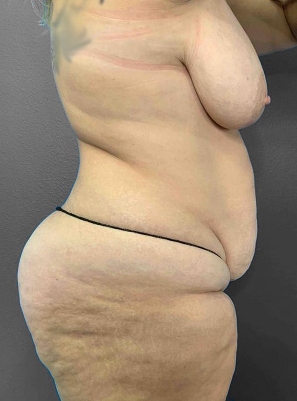 Profile view of a patient highlighting body contouring results at Lentz Plastic Surgery.